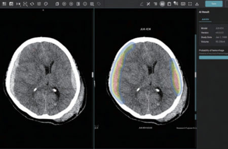 제이엘케이, 美 FDA 뇌졸증 AI 솔루션 JLK-ICH 허가 획득 "연 8600만건 시장성 주목"
